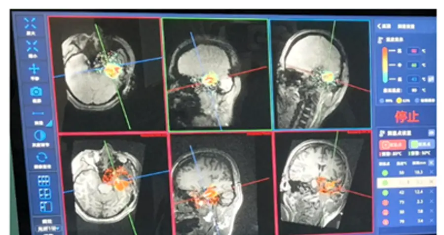 그림 2. MRI 검사실 안에서 실시간으로 한국 환자의 뇌 MRI를 보면서 뇌전증 병소를 레이저로 소각하는 모습. 빨강색 부분 가운데 하얀색 선이 왼쪽 측두엽의 해마가 레이저로 제거되는 모습 (저장대학교 제2병원 제공).