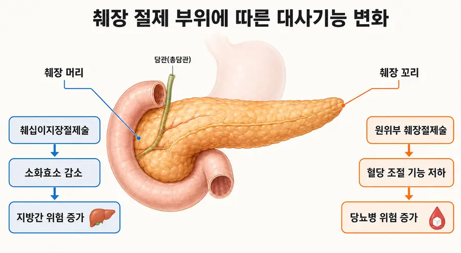 [그림] 췌장 절제 부위에 따른 대사기능 변화 개념도 &nbsp;