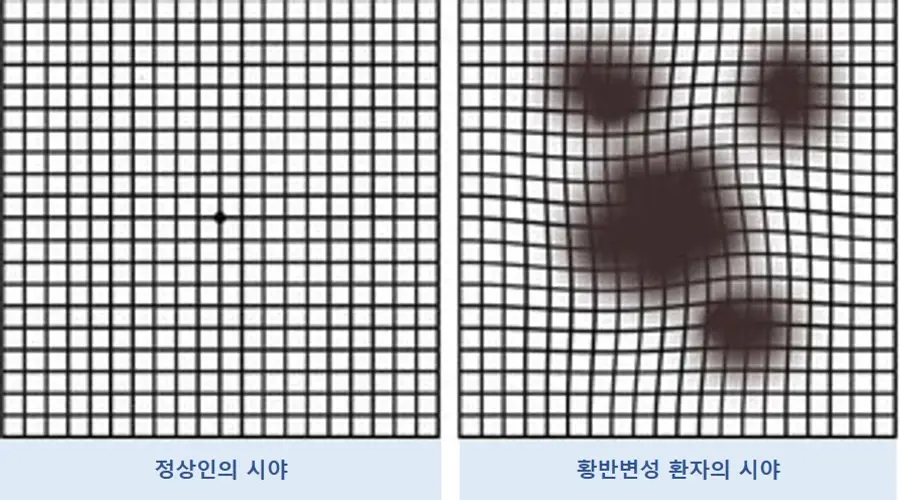 그림2_정상인과 황반변성 환자의 시야