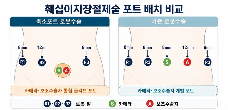 [그림] 췌십이지장절제술 포트 배치 비교. 축소포트는 카메라와 보조수술자가 통합 글러브 포트를 이용한다.
