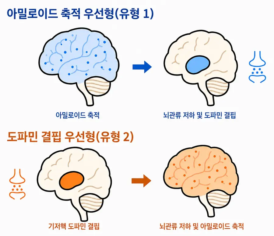 [그림] 루이소체치매 진행유형 구분